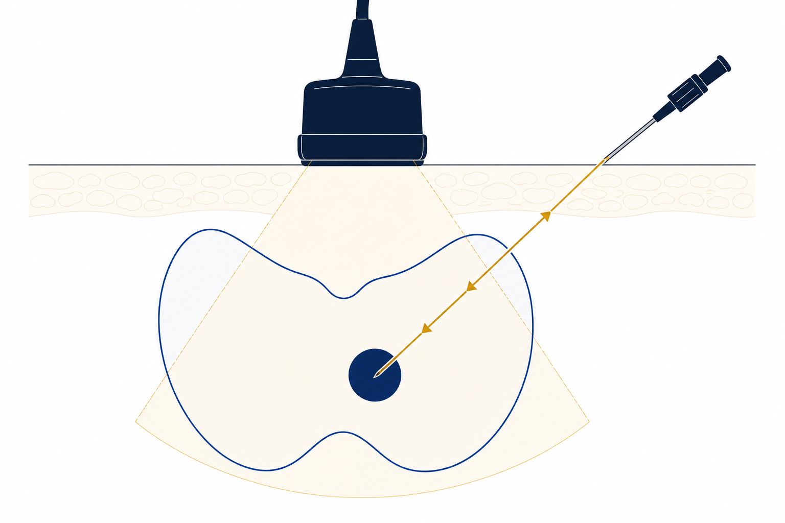 Schema della tecnica di agoaspirato tiroideo eco-guidato in tempo reale